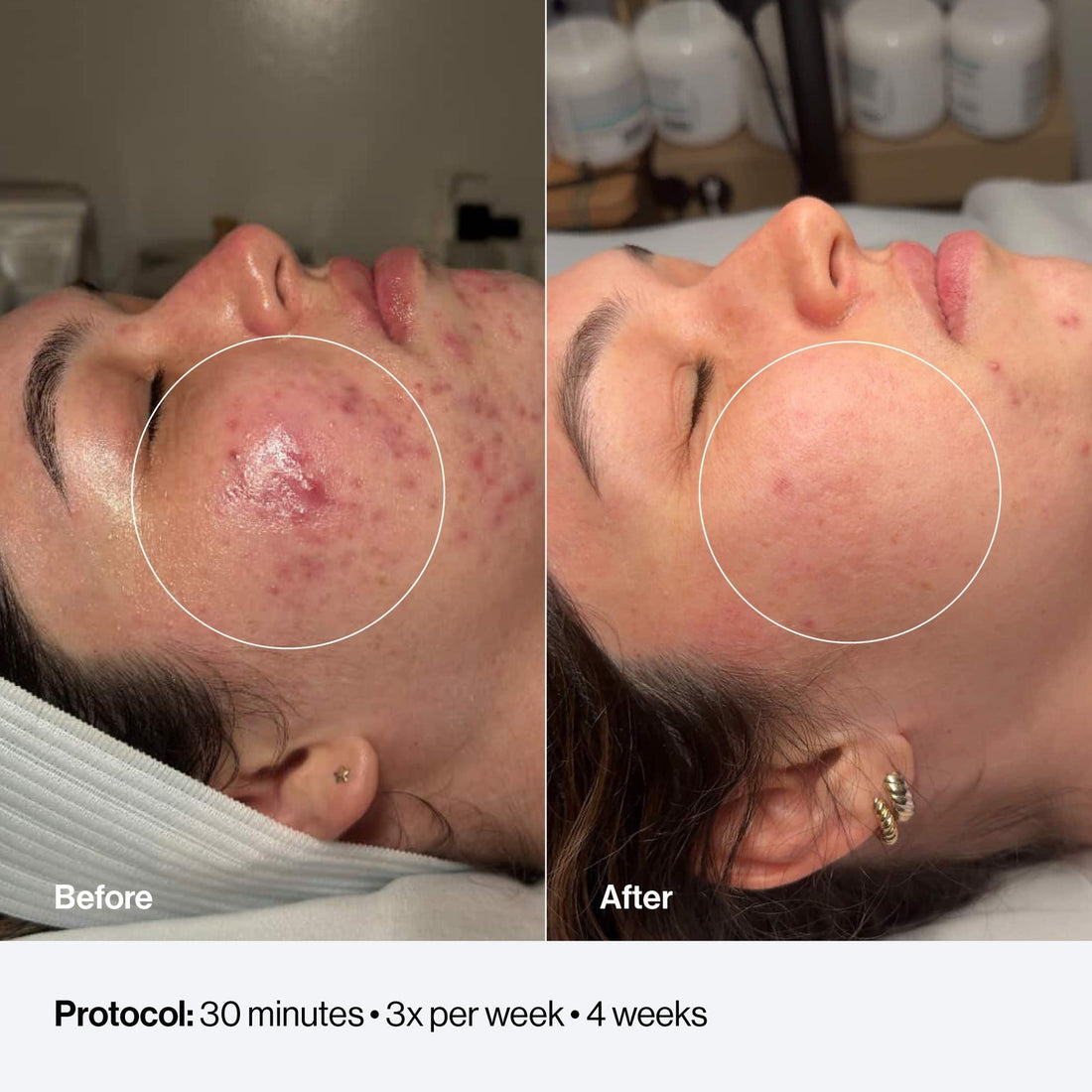 Blue Light for Breakouts: What the Evidence Says